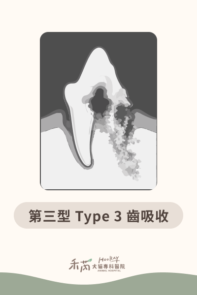第三型 Type 3 齒吸收