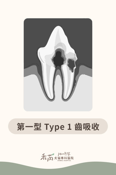 第一型 Type 1 齒吸收