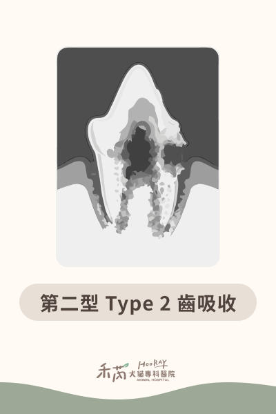 第二型 Type 2 齒吸收